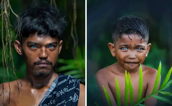 Waardenburg Syndrome