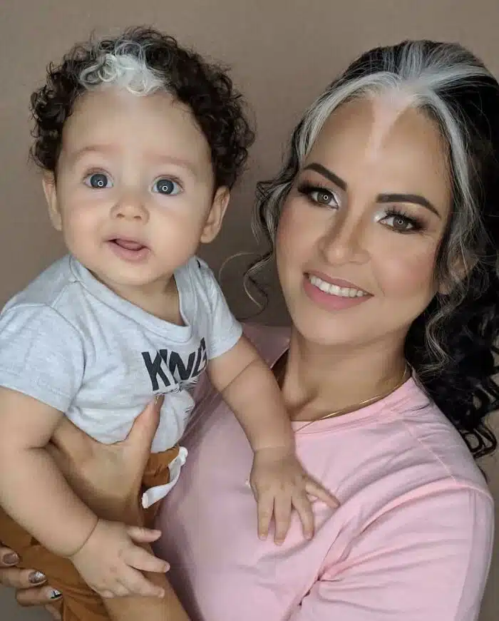 A woman and child with poliosis