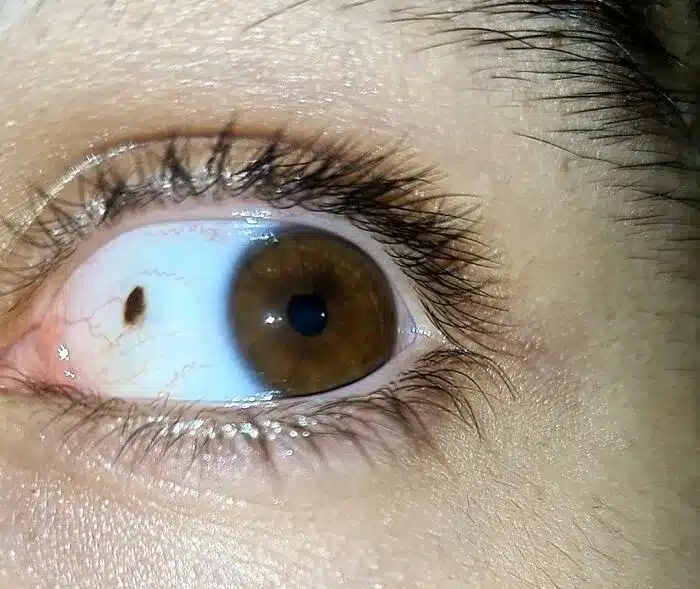 Freckle On My Eye