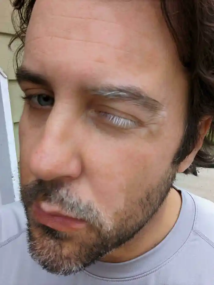 White Lash Vitiligo