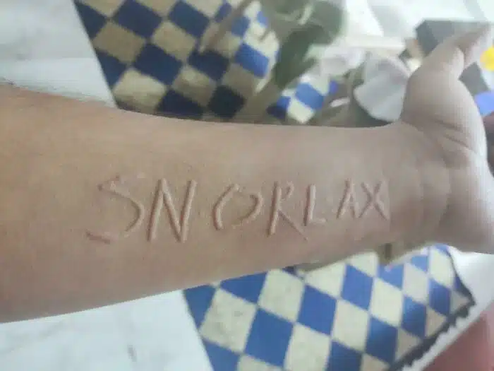 Dermatographia
